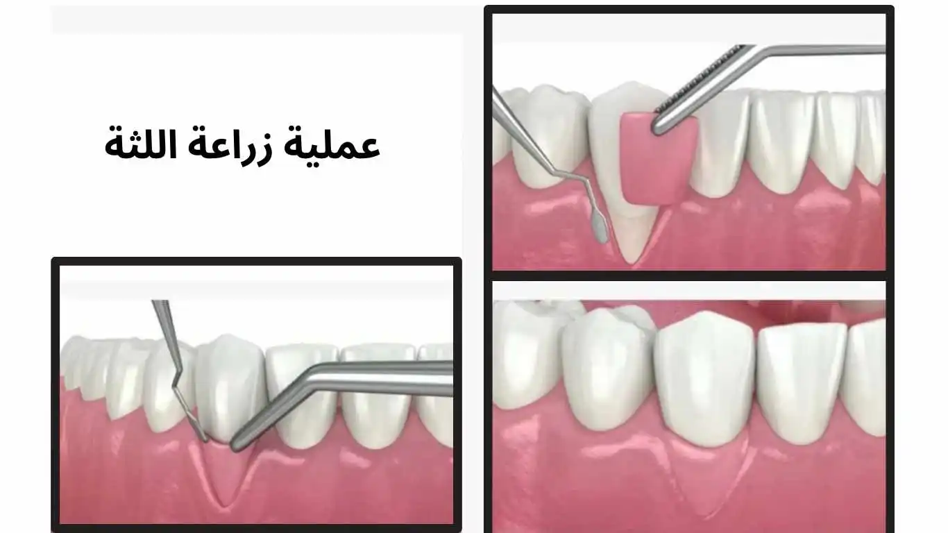  علاج اللثة